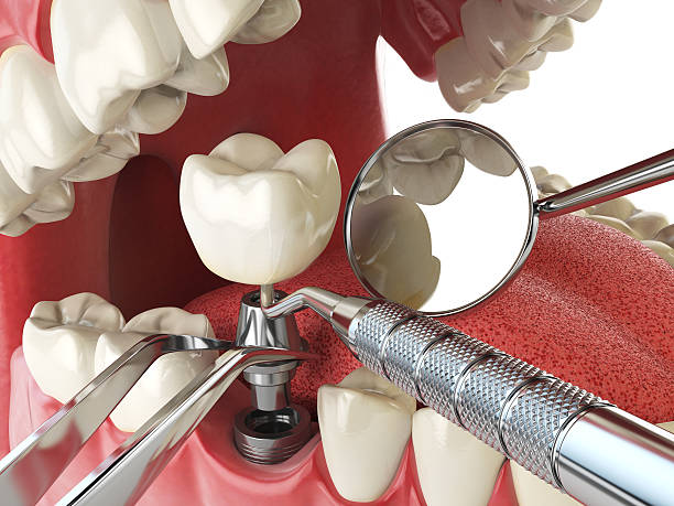 Best Emergency Dental Care for Broken or Chipped Teeth in Fairview, OK